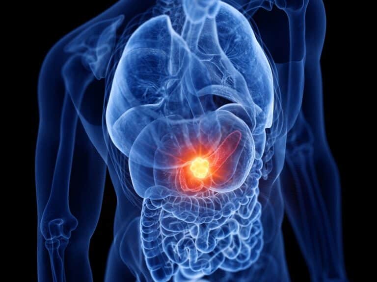 tumori neuroendocrini