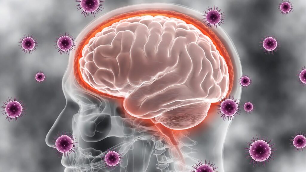 meningite