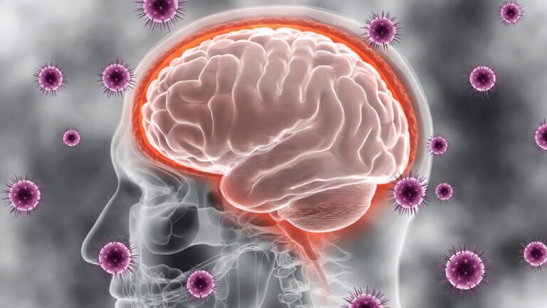 meningite